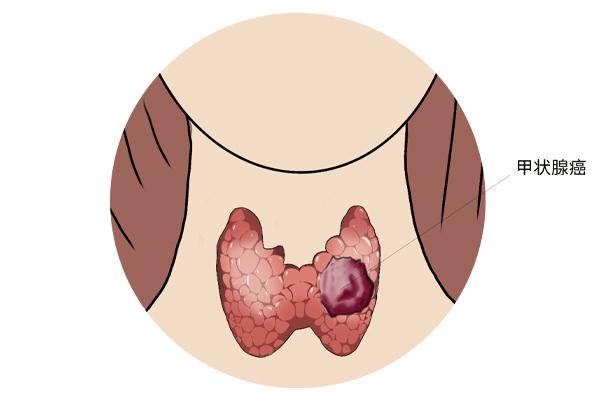 甲狀腺癌癥的主要癥狀表現(xiàn)有什么？為什么會(huì)得甲狀腺癌癥呢？