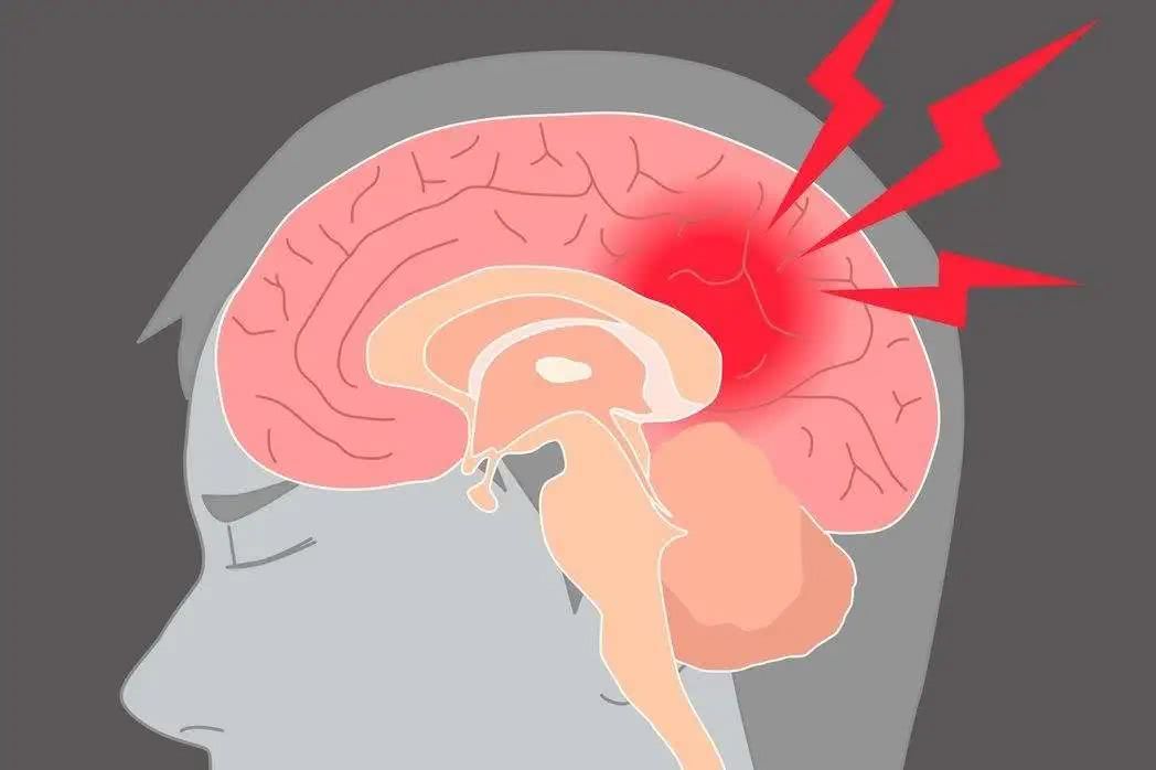 預防腦梗從習慣做起，這三大壞習慣，有的趕緊改正！